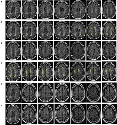 Automatic segmentation of white matter hyperintensities and correlation analysis for cerebral small vessel disease